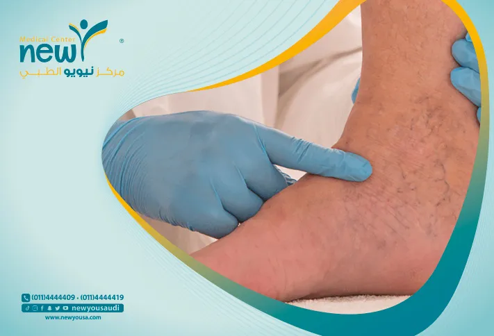 الدوالي كل ما تريد معرفته عنها من خلال مركزنا الطبي في السعودية | نيويو