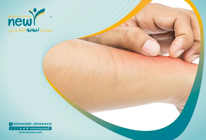 الصدفية مرض جلدي تعرف عليه من خلال مركزنا الطبي في السعودية | نيويو