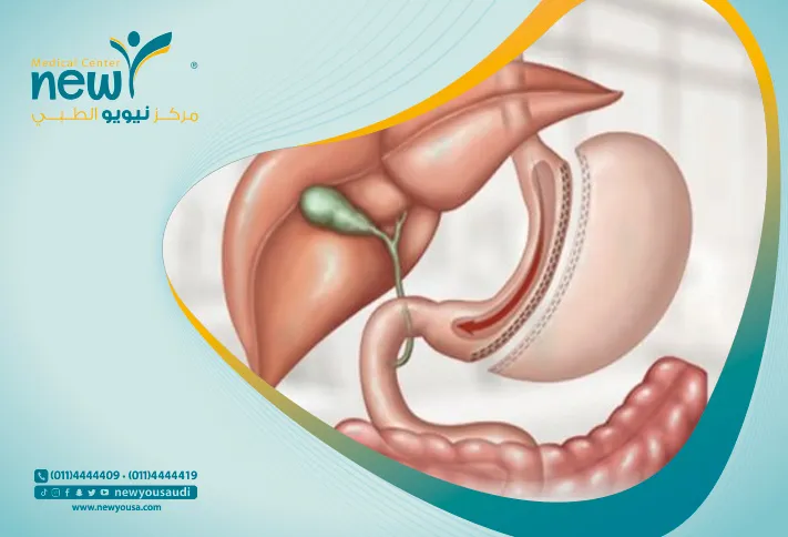 سعر عملية كرمشة المعدة في السعودية عملية كرمشة المعدة كل ما عليك معرفته