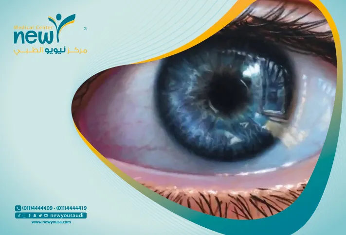 قلع العين  تعرف عليه من خلال مركزنا الطبي في السعودية | نيويو