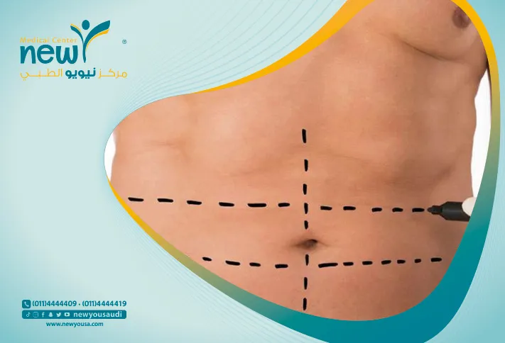 شفط الدهون بالفيزر كل ما تريدي معرفته عنها من خلال مركزنا الطبي في السعودية | نيويو
