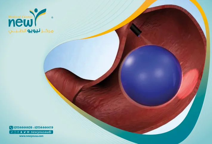 البالون الذكي أفضل وارخص سعر لعملية البالون الذكي في السعودية