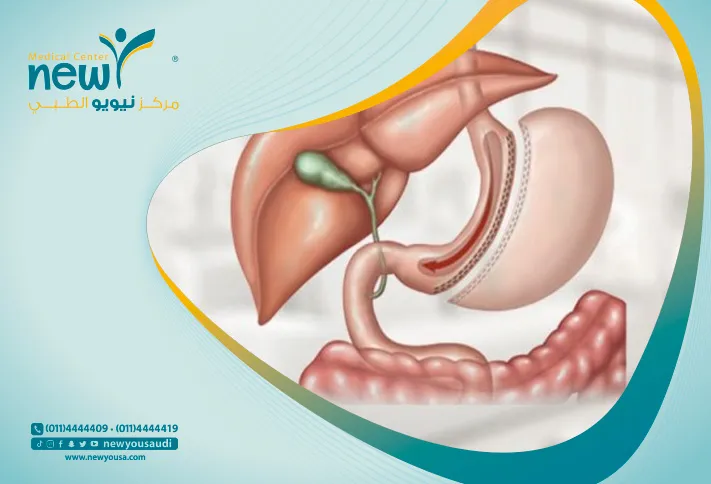 سعر عملية التكميم في السعودية سعر عملية التكميم كل ما عليك معرفته