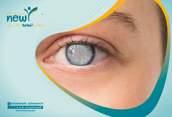 ما بعد عملية المياه البيضاء كل ما تريد معرفته عنها من خلال مركزنا الطبي في السعودية | نيويو