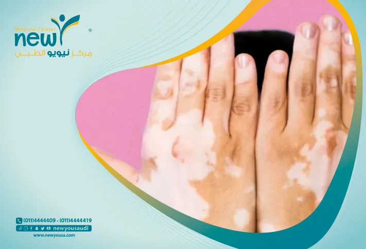 ماهو البهاق تعرف عليه من خلال مركزنا الطبي في السعودية | نيويو