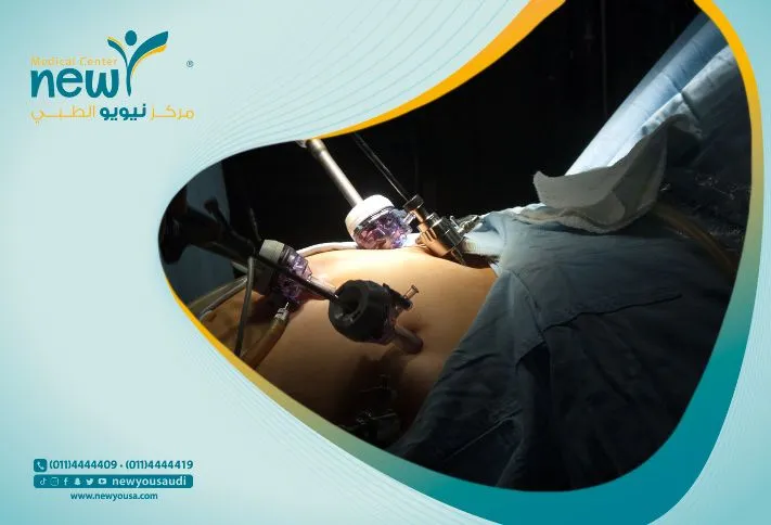 مدة الإفاقة بعد عملية التكميم