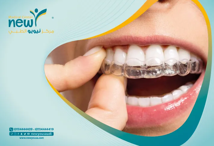 تلبيس الأسنان تعرف عليه من خلال مركزنا الطبي في السعودية | نيويو