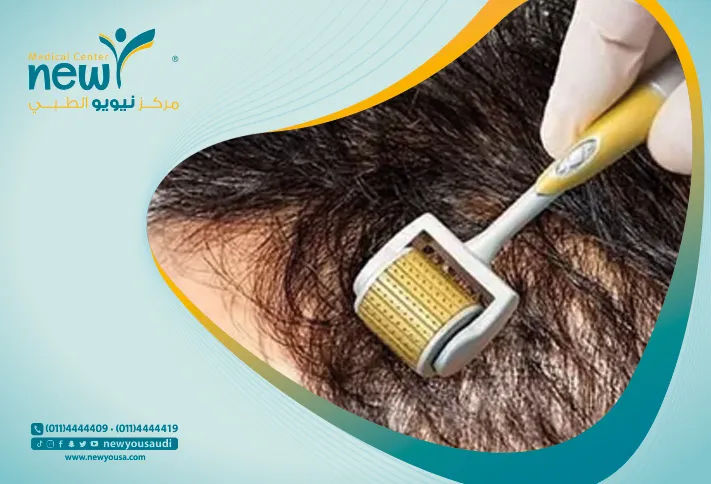 الديرما رولر للشعر؟ تعرف عليه من خلال مركزنا الطبي في السعودية | نيويو