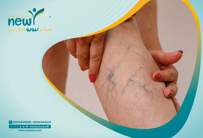 علاج الدوالي كل ما تريدي معرفته عنها من خلال مركزنا الطبي في السعودية | نيويو