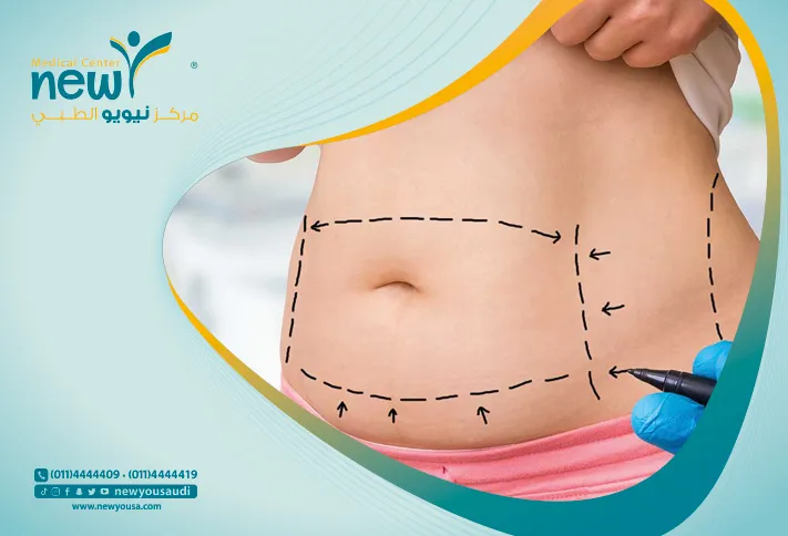 شد البطن بعد الولادة