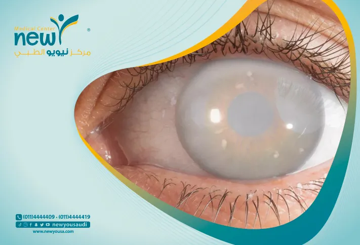 عملية سحب الماء من العين كل ما تريد معرفته عنها من خلال مركزنا الطبي في السعودية | نيويو