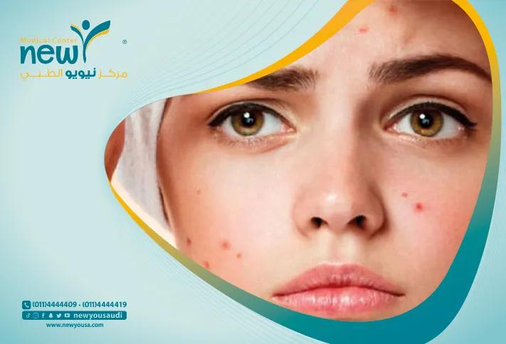 الفراكشنال ليزر كل ما تريد معرفته عنه من خلال مركزنا الطبي في السعودية | نيويو