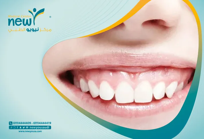 علاج الابتسامة اللثوية