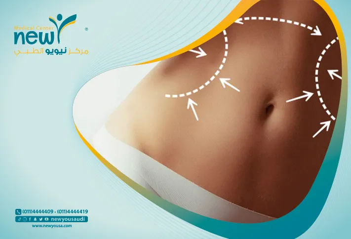 عملية شد البطن بالليزر كل ما تريد معرفته عنها من خلال مركزنا الطبي في السعودية | نيويو