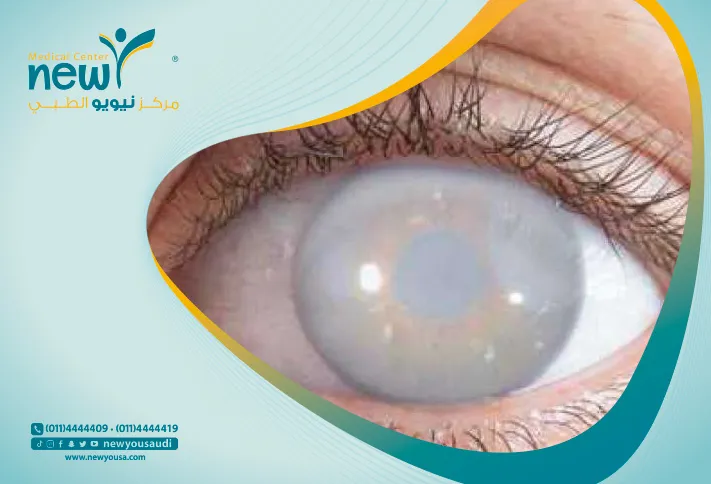 ما بعد عملية المياه البيضاء كل ما تريد معرفته من خلال مركزنا الطبي في السعودية | نيويو