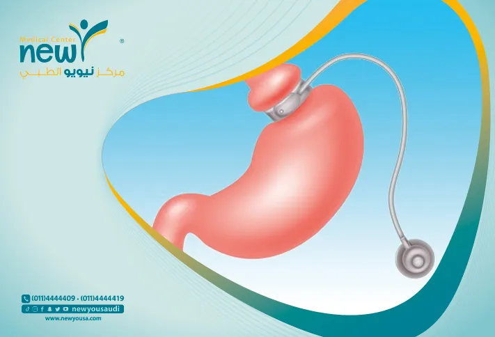 عملية ربط المعدة كل ما تريد معرفته عنها من خلال مركزنا الطبي في السعودية | نيويو