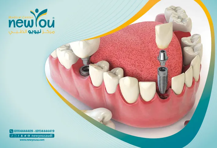 طقم الأسنان تعرف عليه من خلال مركزنا الطبي في السعودية | نيويو