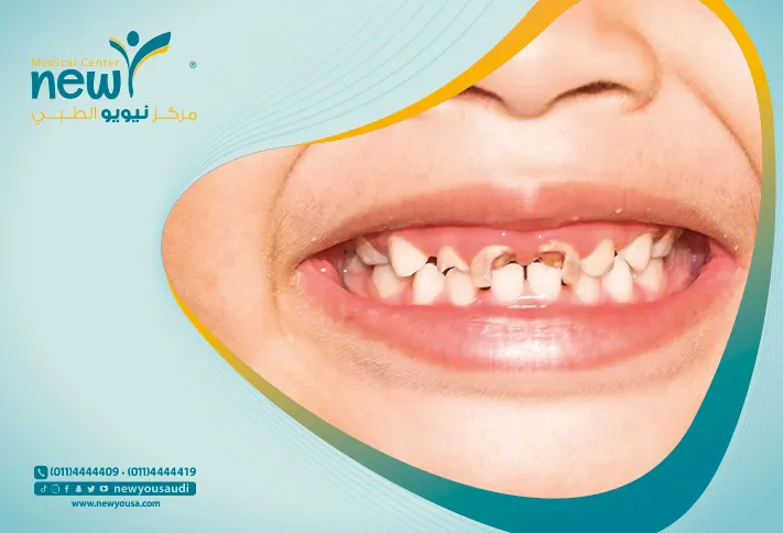 اودي وجديد: كاريسولف، علاج تسوس الأسنان