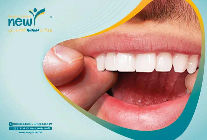 عدسات الاسنان الفينير كل ما تريدي معرفته عنها من خلال مركزنا الطبي في السعودية | نيويو