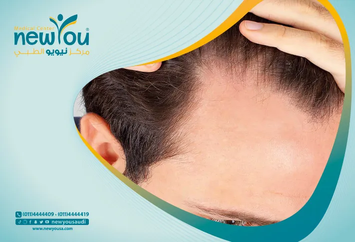 علاج الصلع عند الرجال تعرف عليه من خلال مركزنا الطبي في السعودية | نيويو