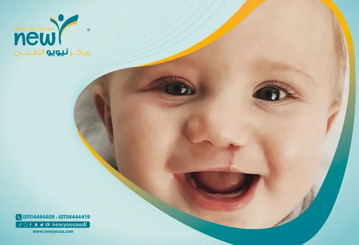 الشفة الأرنبية كل ما تريد معرفته عنها من خلال مركزنا الطبي في السعودية | نيويو