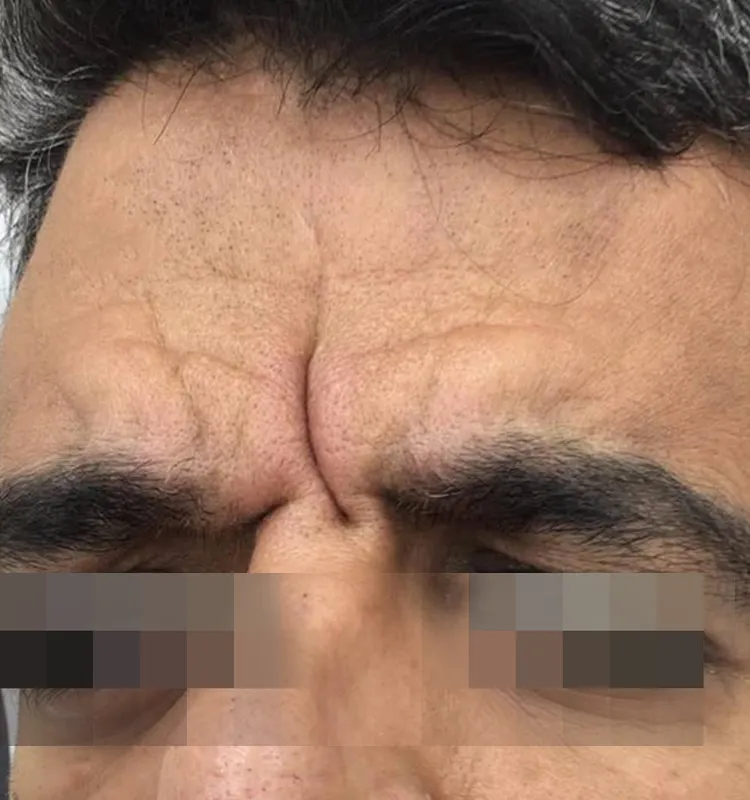 Before - الجلدية