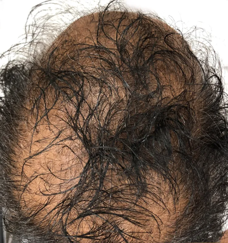 Before - الجلدية