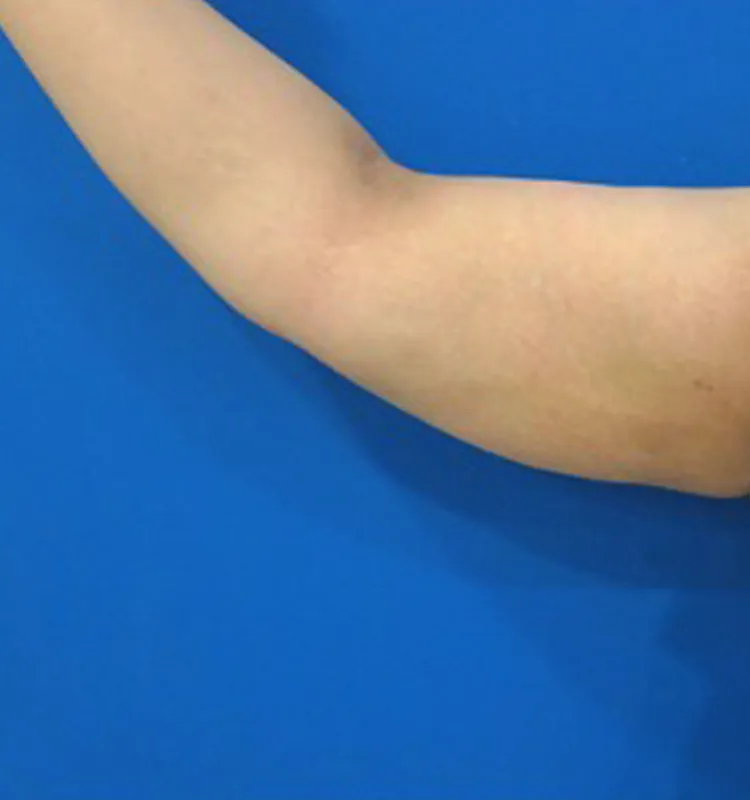 After - التجميل الجراحي