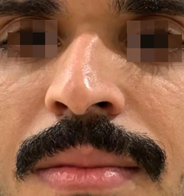 Before - التجميل الجراحي