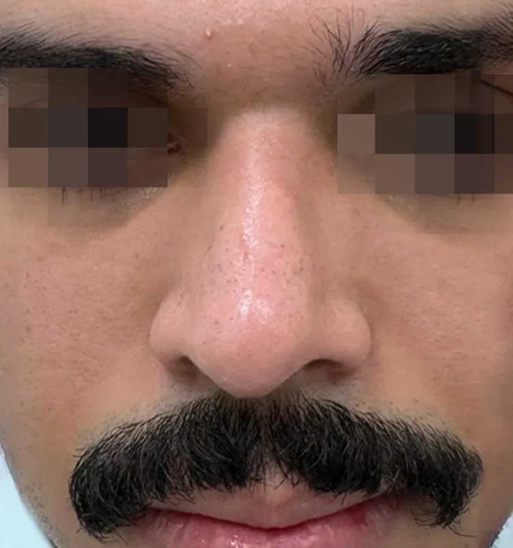 After - التجميل الجراحي