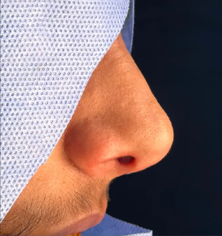 After - التجميل الجراحي