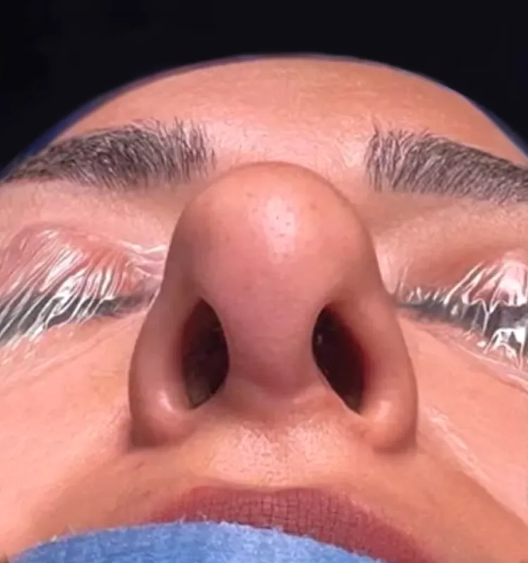 Before - التجميل الجراحي