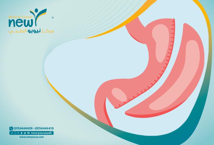 الفرق بين التكميم وجراحات السمنة الأخرى