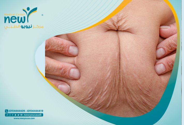 كيف شديت جسمي بعد التكميم