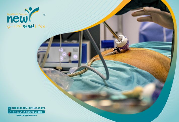 مدة الإفاقة بعد عملية التكميم