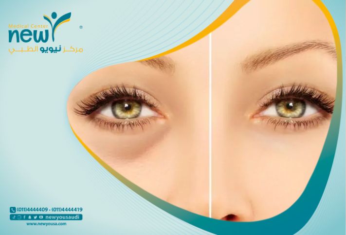 علاج انتفاخ العين بعد البوتكس