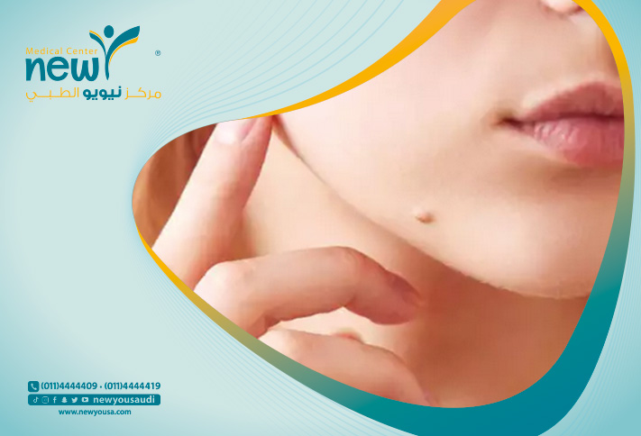 علاج الزوائد الجلدية تعرف عليه من خلال مركزنا الطبي في السعودية | نيويو