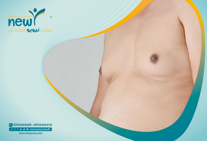 علاج عدم بروز الحلمتين عند الرجال