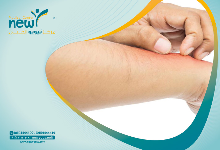 أكزيما اليد تعرف عليه من خلال مركزنا الطبي في السعودية | نيويو