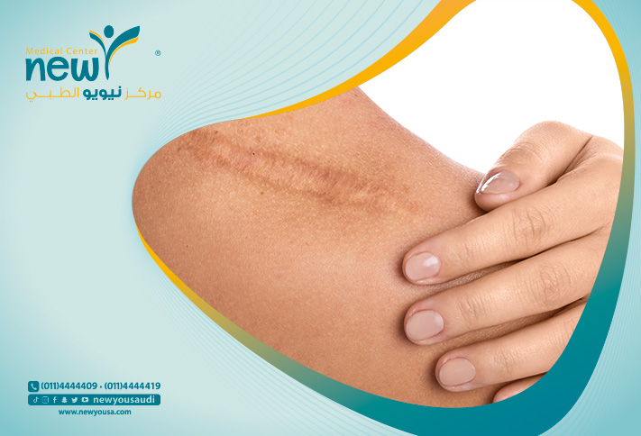 الندبات الجراحية كل ما تريد معرفته عنها من خلال مركزنا الطبي في السعودية | نيويو