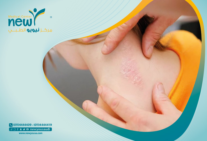 اسباب الصدفيه تعرف عليه من خلال مركزنا الطبي في السعودية | نيويو