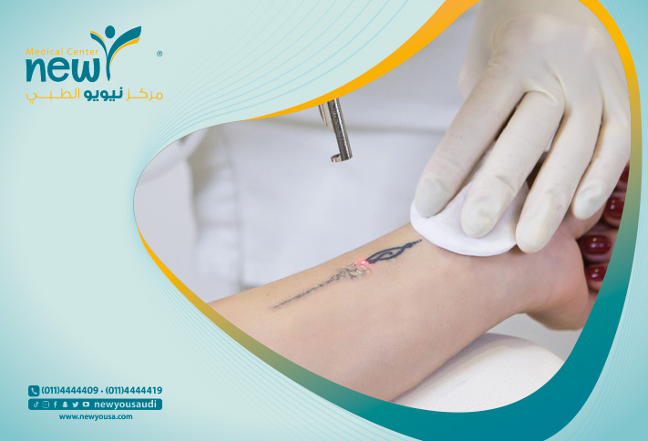 أسعار واماكن إزالة الوشم بالليزر تعرف عليه من خلال مركزنا الطبي في السعودية | نيويو