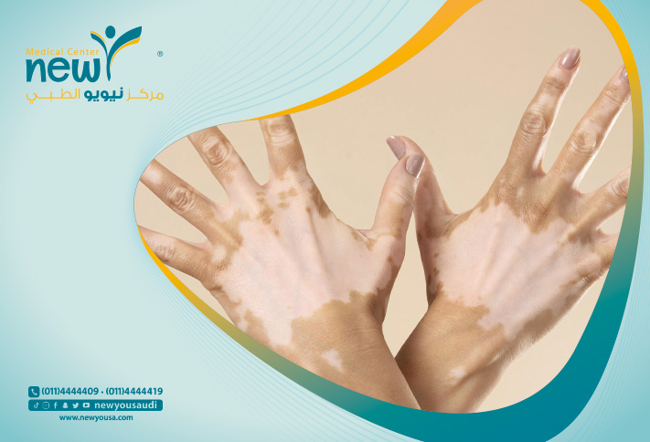 البهاق تعرف عليه من خلال مركزنا الطبي في السعودية | نيويو
