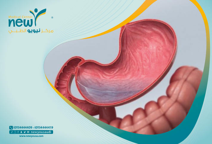 عملية كرمشة المعدة في السعودية سعر كرمشة المعدة كل ما عليك معرفته