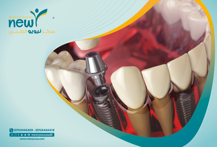 علاجات زراعة الأسنان تعرف عليها من خلال مركزنا الطبي في السعودية | نيويو