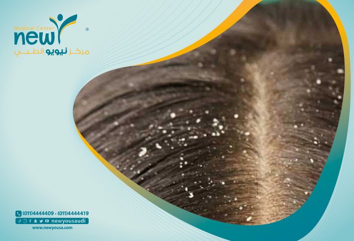 ازالة القشرة من الشعر امر مرهق للكثير خاصتا الشباب في عمر المراهقة