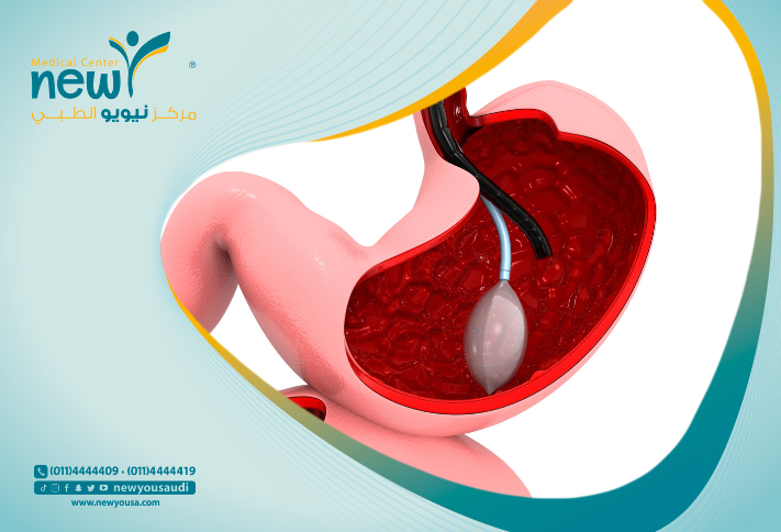 فوائد البالون للمعدة