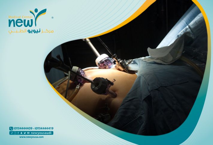 مدة الإفاقة بعد عملية التكميم
