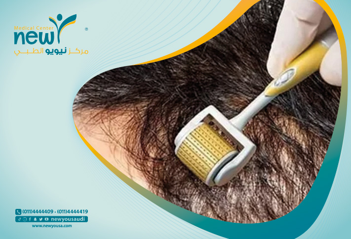 الديرما رولر للشعر؟ تعرف عليه من خلال مركزنا الطبي في السعودية | نيويو
