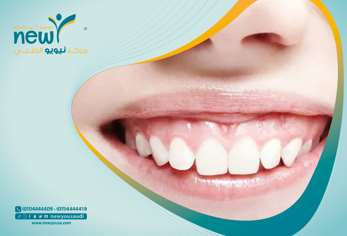 علاج الابتسامة اللثوية